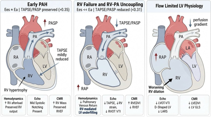 Beyond the right ventricle: left heart involvement in pulmonary arterial hypertension