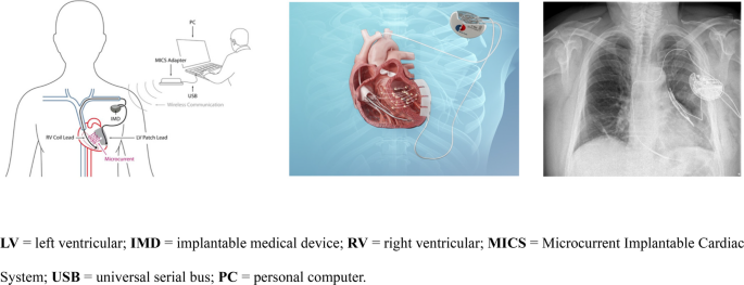 Cardiac microcurrent therapy in heart failure: Mechanistic rationale, early clinical evidence, and future directions