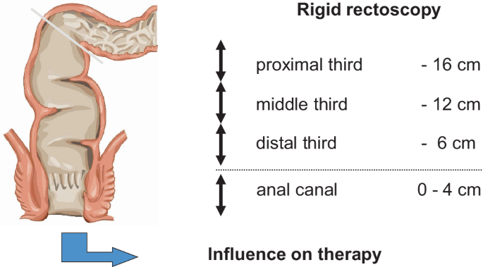 A modern approach to rectal cancer