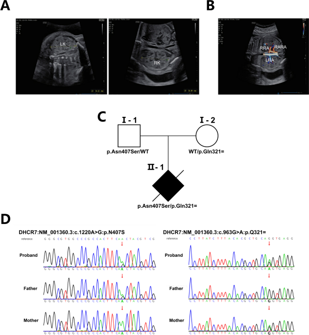 A novel pathogenic synonymous DHCR7 variant unveiled by aberrant splicing in Smith-Lemli-Opitz syndrome