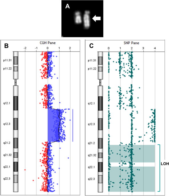 Long-read genome sequencing resolves a de novo complex 18q12.1q21.2 triplication causing partial tetrasomy and reveals its underlying mechanism