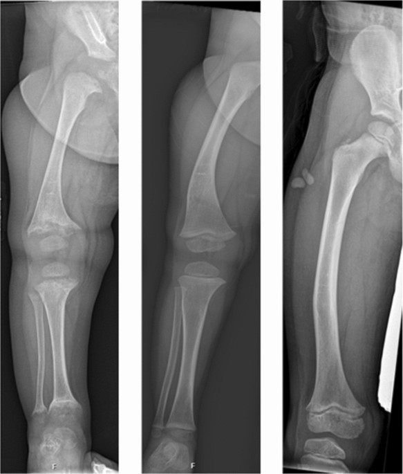 When X Does Not Mark the Spot: Autosomal Dominant and Recessive Forms of Renal Hypophosphatemic Rickets and Osteomalacia