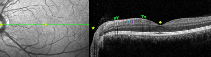 Primer on Optical Coherence Tomography for the Neurologist