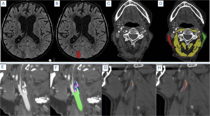 The Use of AI in Neuroimaging-guided Decision Making in Acute Ischemic Stroke