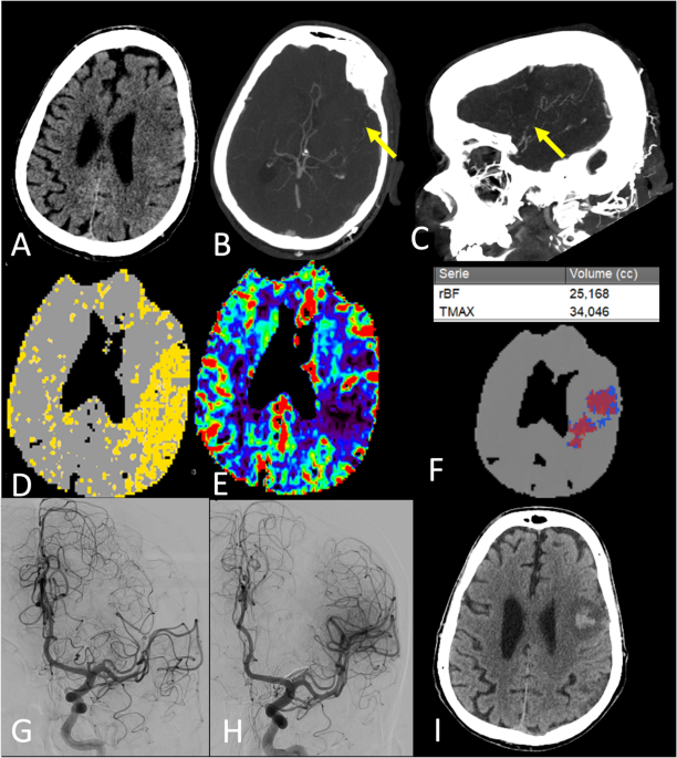 Treatment Decision-Making in Distal-Medium Vessel Occlusions: A Case-Based Perspective Review