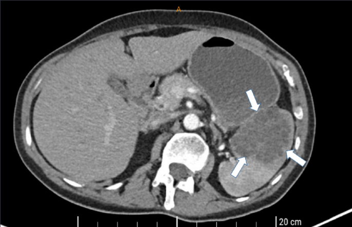 Primary splenic Alveolar Echinococcosis: a case report from Germany
