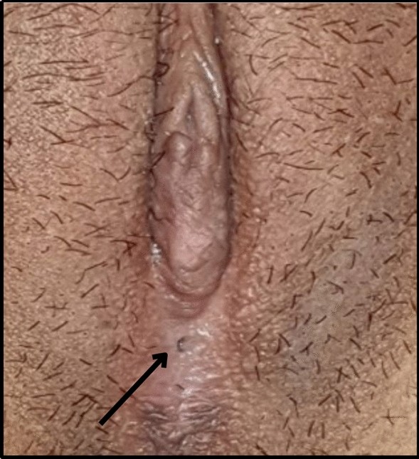 A Rare Case of Complete Labial Fusion due to Trauma in a Young Unmarried Women: A Case Report