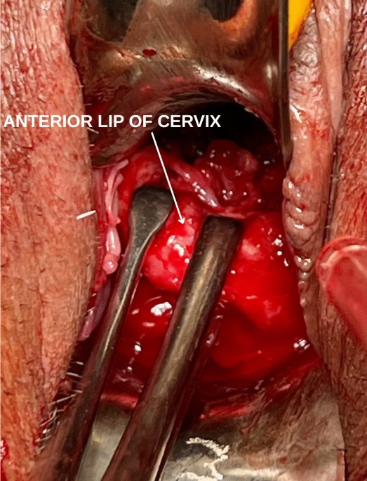 The Double Anomaly: Carcinosarcoma in OHVIRA Syndrome