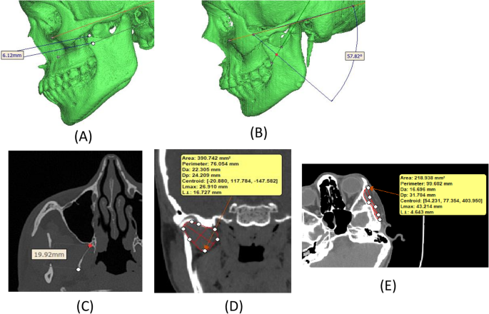 Morphometric analysis of craniofacial skeletal and masticatory muscle morphology in patients with temporomandibular disorders: An observational study