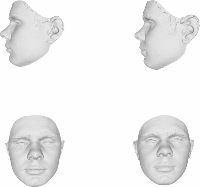 The impact of clockwise and counterclockwise Le Fort I movements combined with bilateral sagittal split osteotomy on nasal morphology