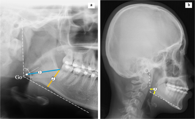 Mandibular ramus split patterns following sagittal split ramus osteotomy – evaluation with multifactorial risk analysis