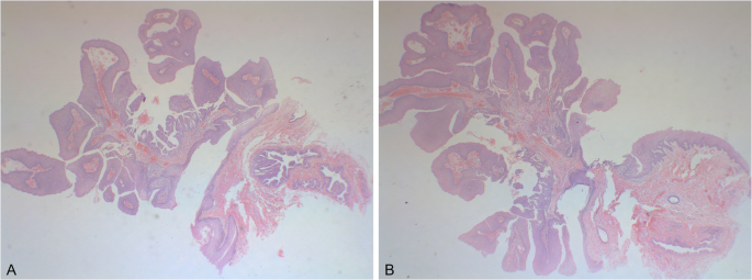 Sialadenoma papilliferum of the floor of the mouth with HPV Positivity: a rare case report and literature review