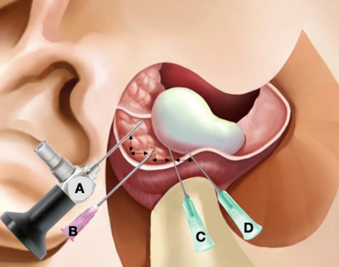 Arthroscopy-assisted inferior compartment arthrocentesis of the temporomandibular joint