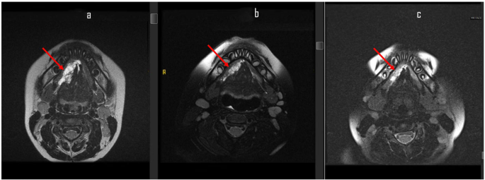 Successful management of lymphangioma circumscriptum of the tongue with sirolimus monotherapy: a case report