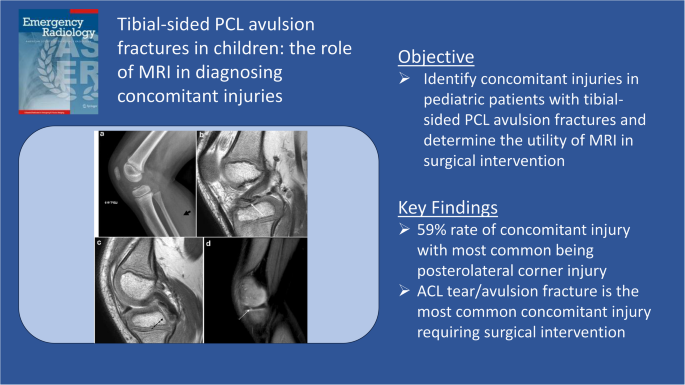 Tibial-sided PCL avulsion fractures in children: the importance of diagnosing concomitant injuries