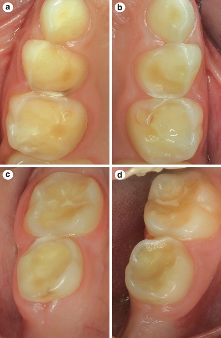 Dental erosion and erosive tooth wear in childhood and adolescence: from diagnosis to prevention