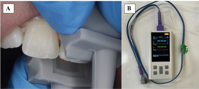 A cross-sectional study of pulpal oxygen saturation in permanent incisors affected by molar incisor hypomineralisation (MIH)