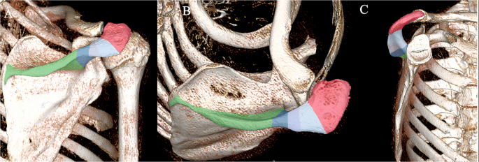 Acromial Stress Fractures in Reverse Total Shoulder Arthroplasty: Diagnosis, Prevention, and Treatment