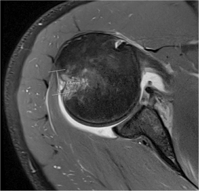 When an Isolated Bankart Repair is Not Enough: Comparing Latarjet Versus Augmentation with Remplissage