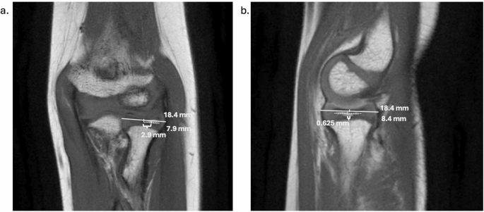 Ossification of the Pediatric Elbow with a Focus on Radial Head Ossification Patterns