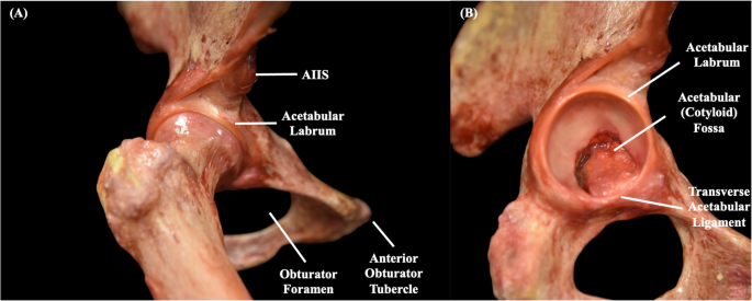 The Management of Acetabular Labral Tears: A Contemporary Review