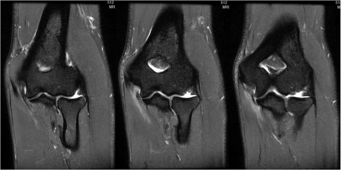 Management of Ulnar Collateral Ligament Injuries of the Elbow