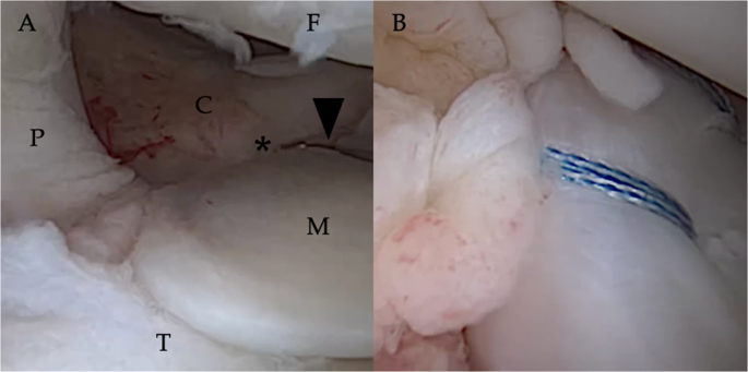 Meniscus Pathology in the Setting of Revision ACL Surgery: Unique Considerations