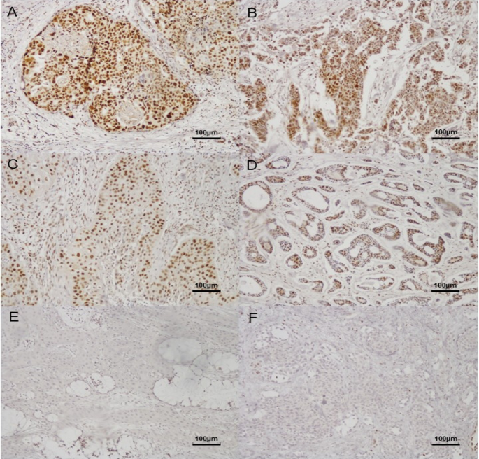 Histological heterogeneity of SLFN11 expression and its association with response to carboplatin plus paclitaxel therapy in salivary gland cancer