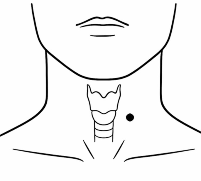 Influence of Posture, Viscosity, and Neck Circumference on Swallowing Acoustics: A Mixed-Effects Analysis
