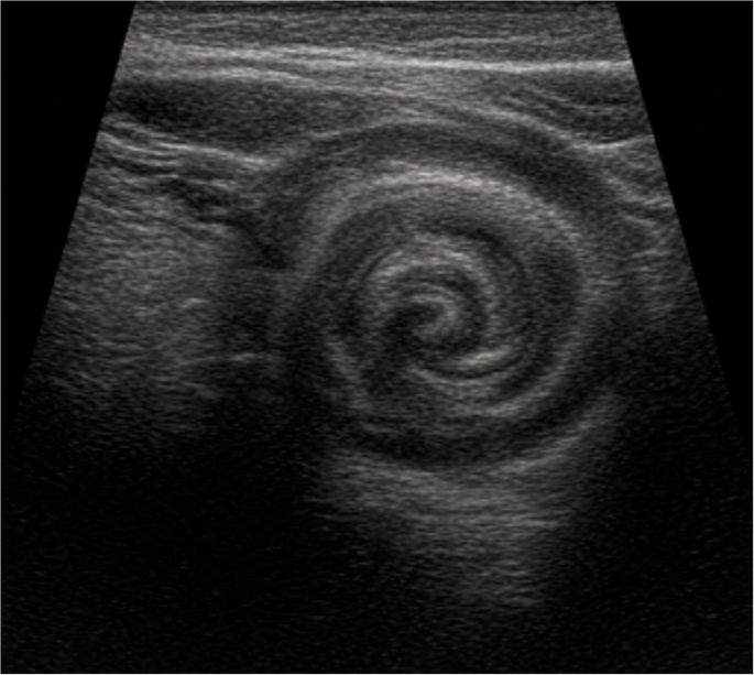 Recent Technological Advances in the Diagnosis of Testicular Torsion in the Emergency Department