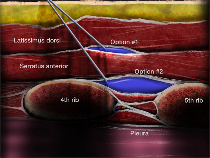 Rib Fracture Pain Management: Current Considerations and Clinical Practice Updates With a Focus on Ultrasound-Guided Regional Anesthesia in the Emergency Department