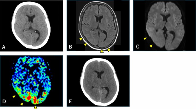 Fulminant hyperammonemia during intensive chemotherapy in the setting of previously unrecognized partial ornithine transcarbamylase deficiency