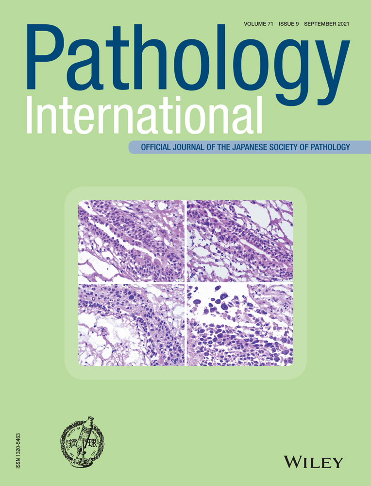 Activating HRAS mutation in a case of inverted ductal papilloma of the salivary gland