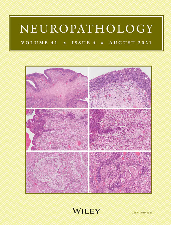 “Burnt‐out” progressive multifocal leukoencephalopathy in idiopathic CD4+ lymphocytopenia