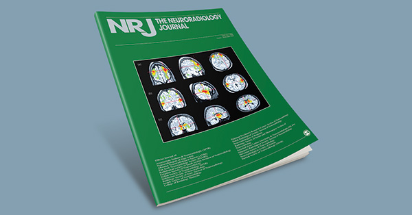Acquired pial arteriovenous fistula secondary to cerebral cortical vein thrombosis: A case report and review of the literature