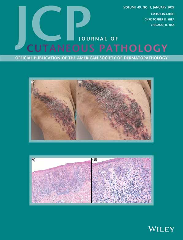 Kaposi sarcoma: What to do with a negative human herpesvirus 8 immunohistochemical stain?