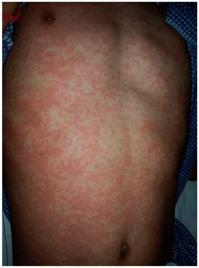 Dermatopathology, Vol. 9, Pages 164-171: Drug-Induced vs. Viral Maculopapular Exanthem&mdash;Resolving the Dilemma
