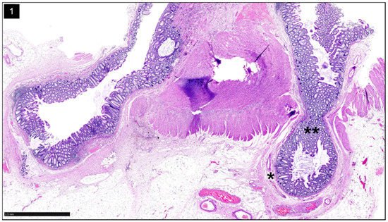Gastroenterology Insights, Vol. 13, Pages 326-339: Diverticular Disease&mdash;An Updated Management Review