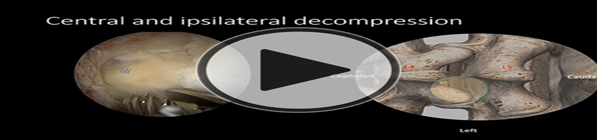 Unilateral Biportal Endoscopy for Lumbar Spinal Stenosis and Lumbar Disc Herniation