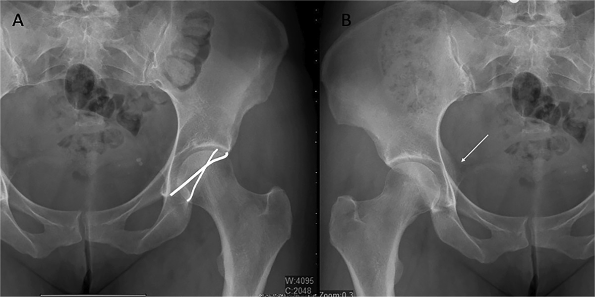 Acetabular Rim Disorders: Epidemiology, Etiology, Management, and Outcomes