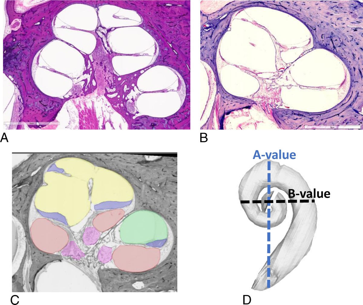 Incomplete Partition Type II Cochlear Malformations: Delineating the Three-Dimensional Structure from Digitized Human Histopathological Specimens