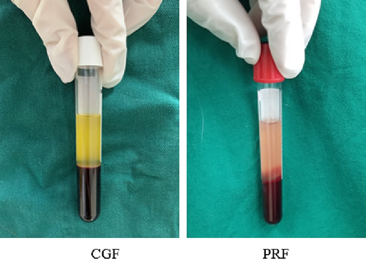 Study on the Application of Concentrated Growth Factor Combined With Adipose Transplantation in Repairing Depressed Deformities of Soft Tissue in the Face