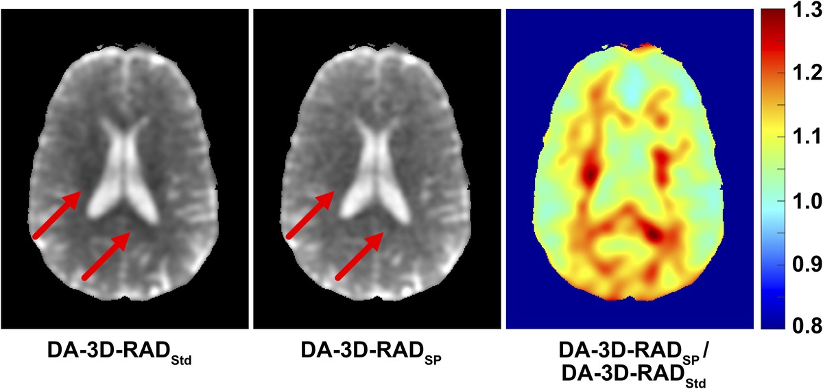 Influence of Residual Quadrupolar Interaction on Quantitative Sodium Brain Magnetic Resonance Imaging of Patients With Multiple Sclerosis