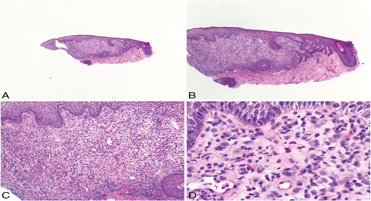 A Rare Presentation of an Isolated Vulvar Lesion in an Elderly Female: Challenge