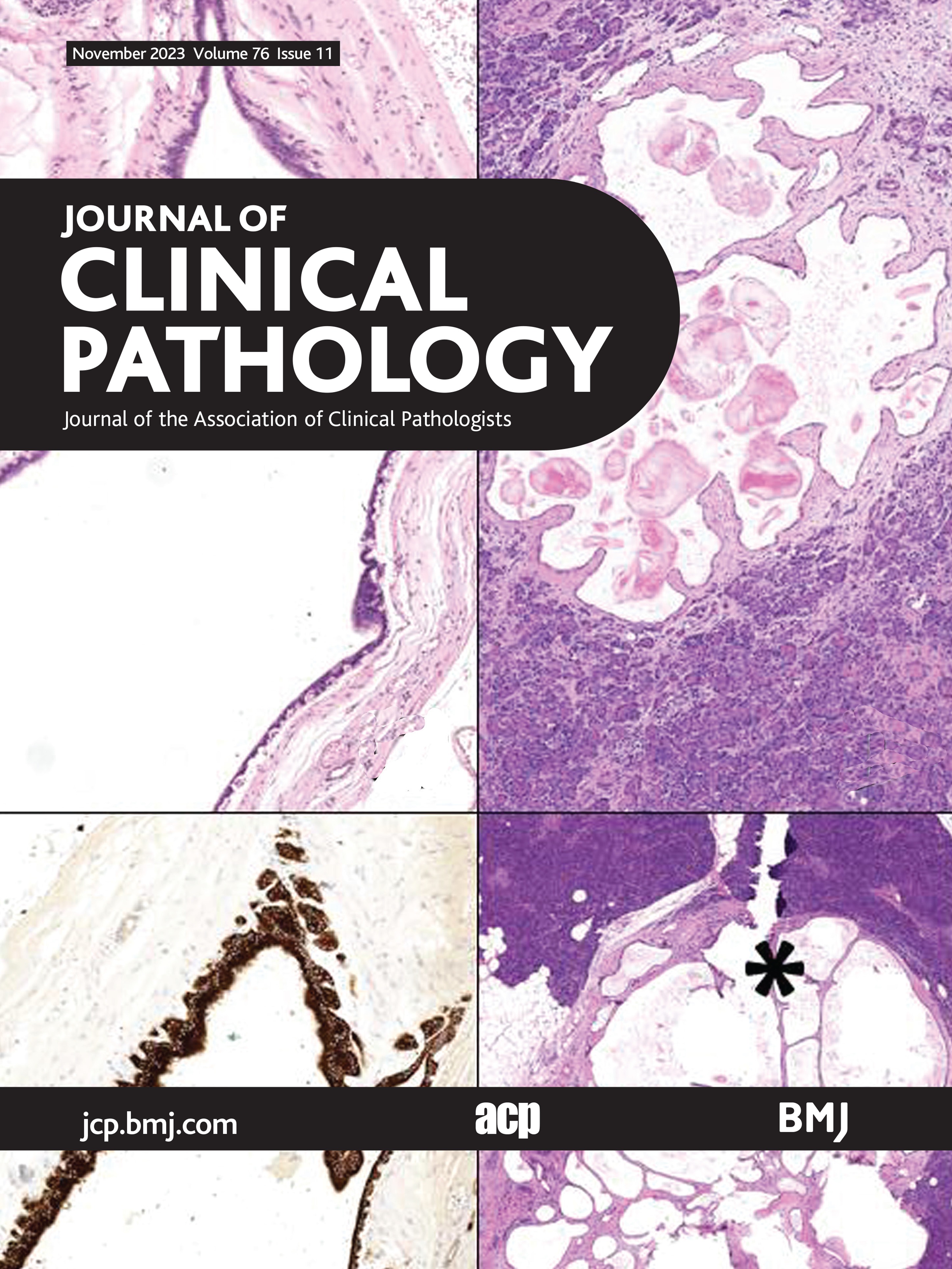 Comprehensive characterisation of acinar cystic transformation of the pancreas: a systematic review