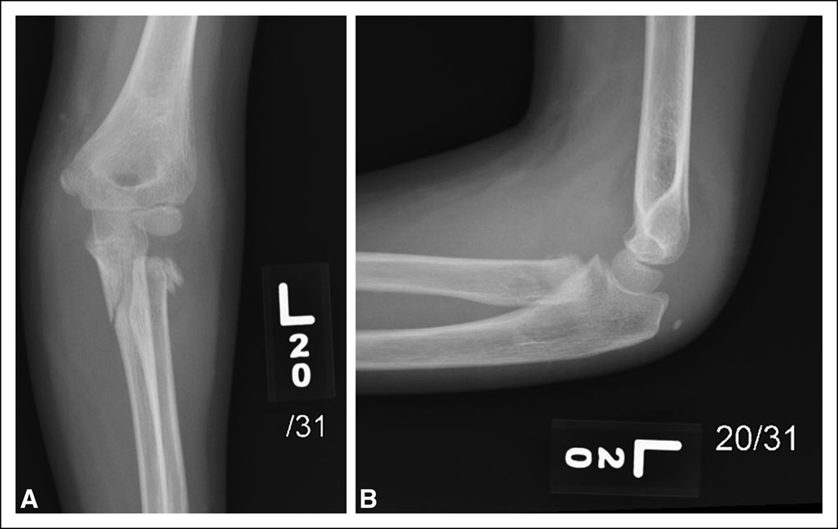 Recurrent Infections After Percutaneous Pinning of a Proximal Radius and Ulna Fracture