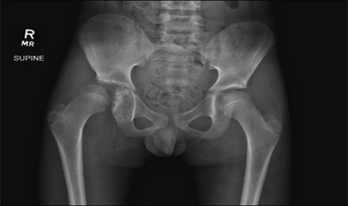 Isolated Dysplasia Epiphysealis Hemimelica (Trevor Disease) of the Acetabulum: Literature Review