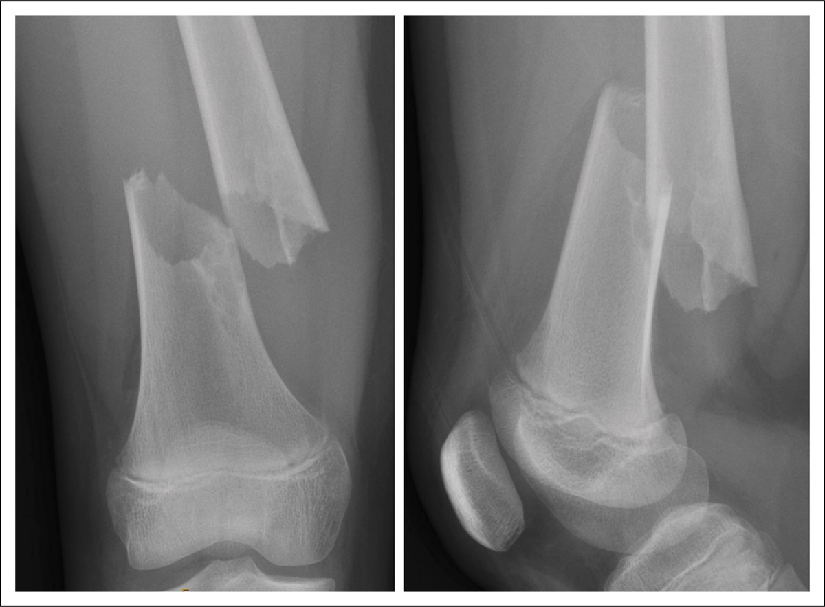 Distal Femur Valgus Deformity After Rigid Intramedullary Nailing of Adolescent Femoral Shaft Fracture