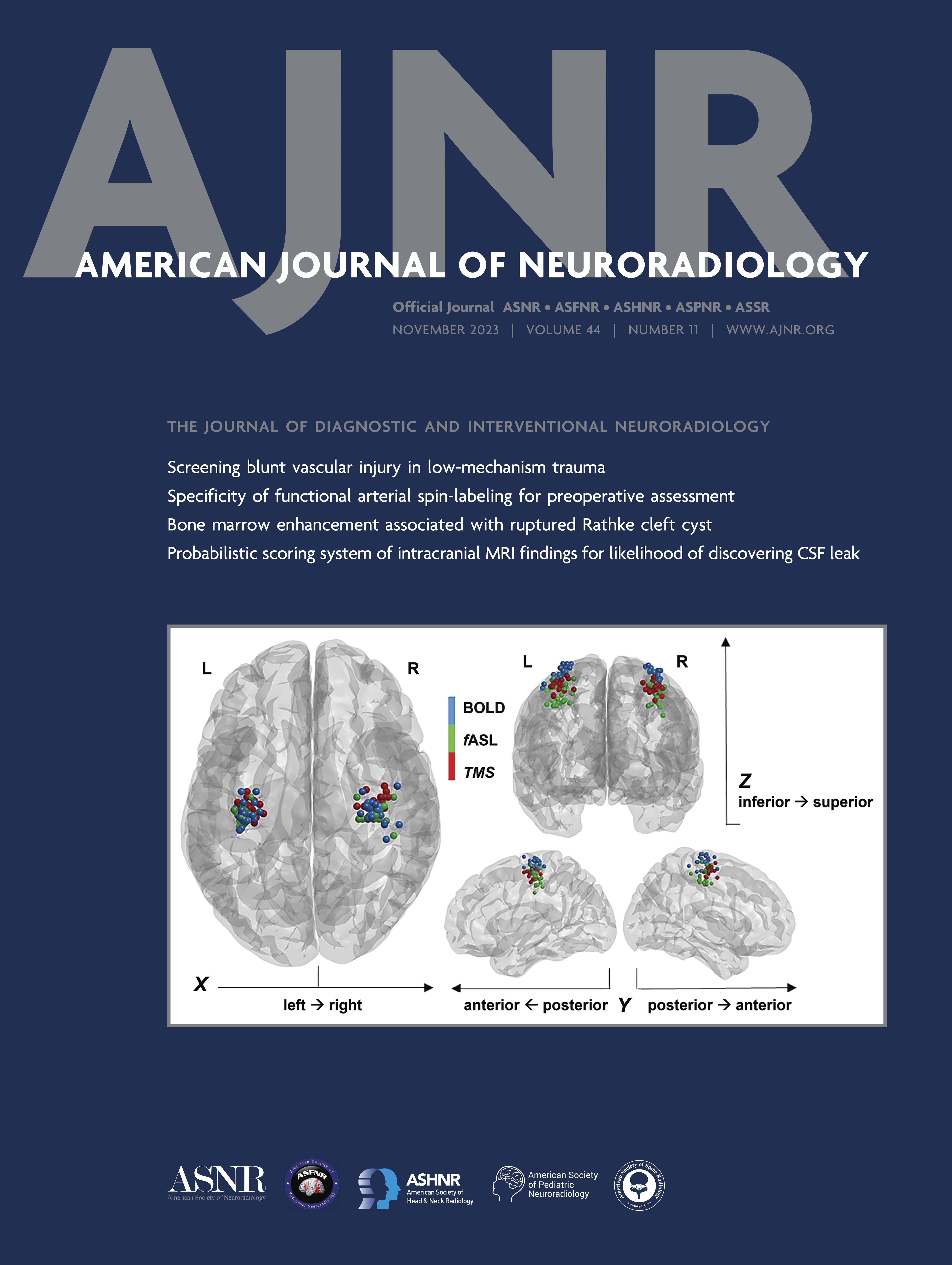 Impact of Balloon Guide Catheters in Elderly Patients Treated with Mechanical Thrombectomy: Insights from the ROSSETTI Registry [NEUROINTERVENTION]