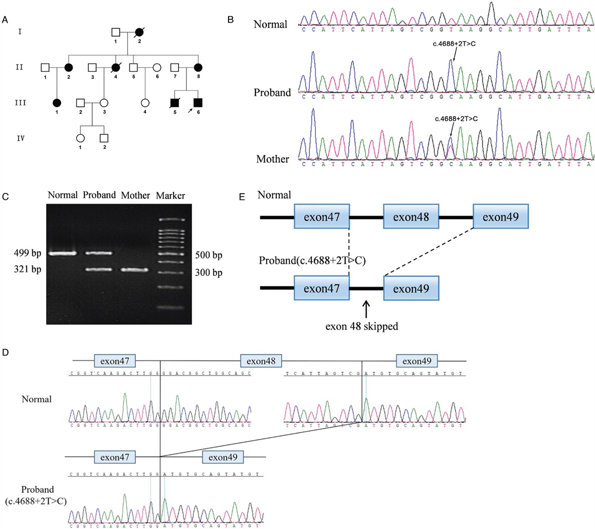 Identification and functional characterization of a novel truncating splicing variant in COL4A5 gene causing X-linked Alport syndrome with astigmatism